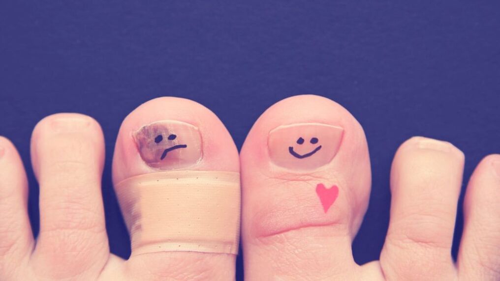 hřebík s plísní a zdravý